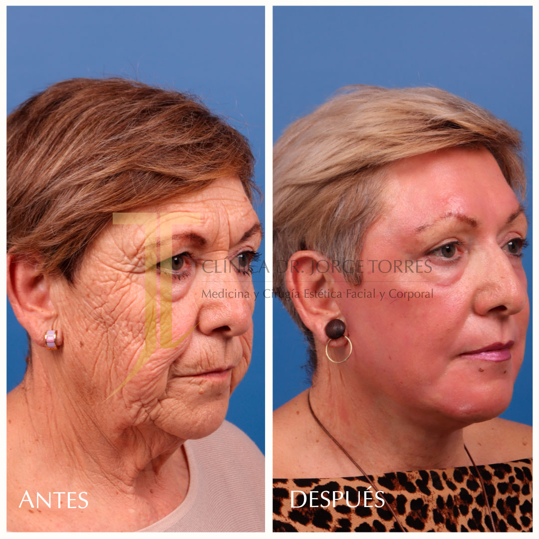 PACIENTE TRATADO CON PEELING PROFRUNDO MÁS LEFFTING CERBICO FACIAL 
